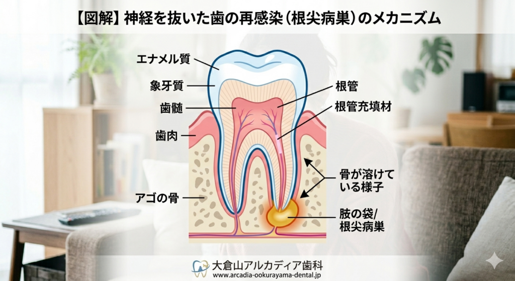 大倉山アルカディア歯科が解説する根管治療。神経を抜いた歯の根っこに膿が溜まる根尖病巣の図解です。大倉山アルカディア歯科が解説する根管治療。神経を抜いた歯の根っこに膿が溜まる根尖病巣の図解です。