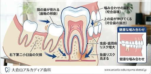 大倉山アルカディア歯科が図解。抜けた歯を放置して隣の歯が倒れ上の歯が伸びるドミノ倒しの様子です。