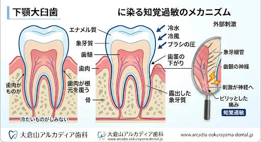 大倉山アルカディア歯科が図解。歯茎が下がり露出した象牙質に刺激が伝わりしみる知覚過敏の仕組みです。