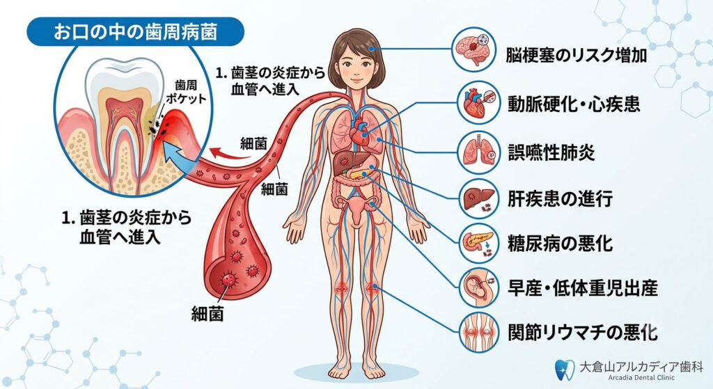 大倉山アルカディア歯科が図解。歯周病菌が全身の病気に悪影響を及ぼす仕組みです。