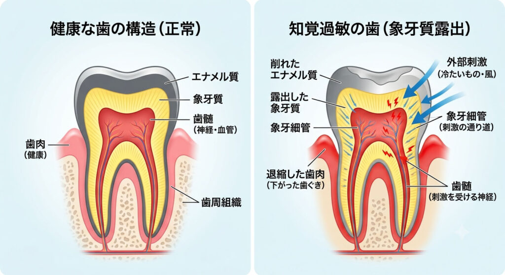 大倉山アルカディア歯科が図解。象牙質が露出して知覚過敏になる仕組みです。