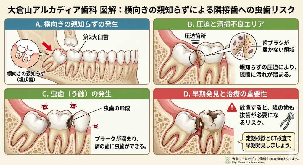 大倉山アルカディア歯科が図解。横向きの親知らずが手前の歯を圧迫し虫歯になるリスクです。